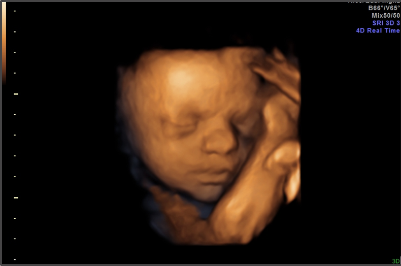  Two Polls Show Florida Amendment for Abortions Up to Birth Will Fail 