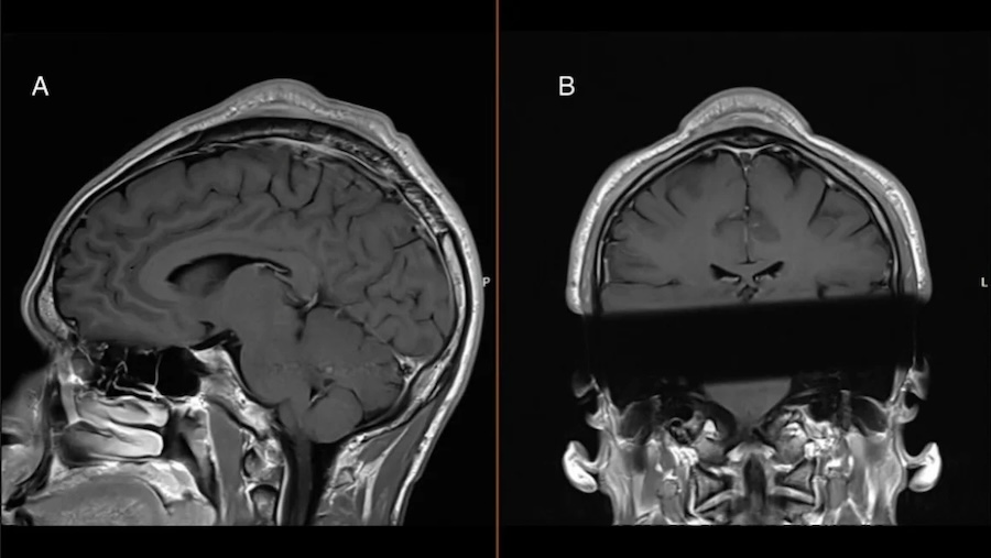  ‘Headspin hole’: Man develops foot-long scalp tumor after decades of breakdancing 