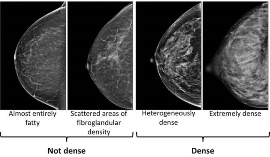  Breast density increases breast cancer risk, according to health experts 