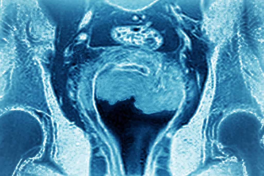  Uterine cancer among most common forms of cancer. A doctor explains what to know about it 