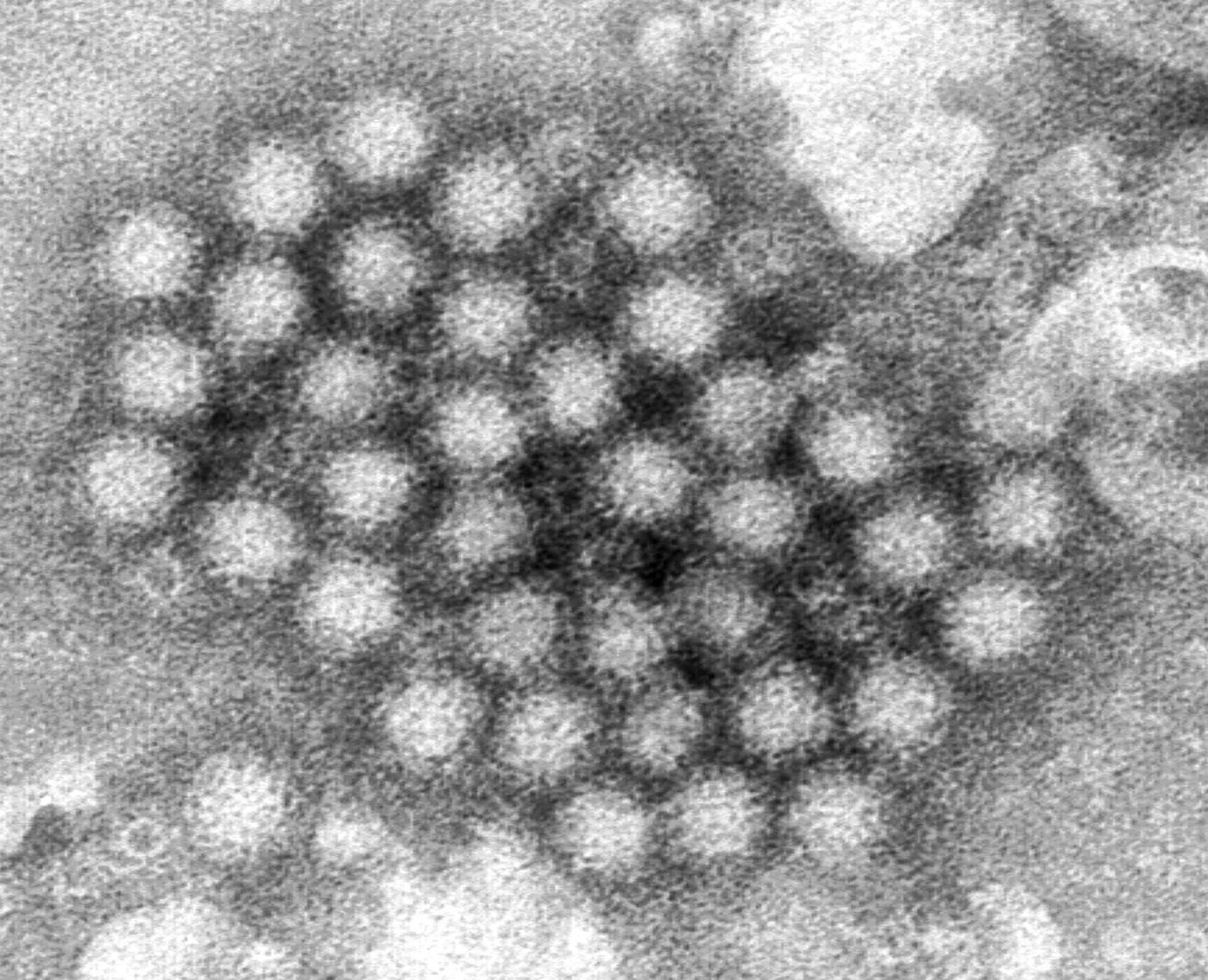  Reports of norovirus, other seasonal illnesses climb in Colorado 