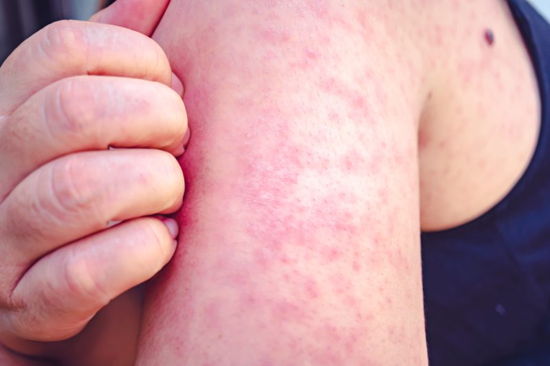  Lubbock officials urge vaccination after area's first measles case in 21 years 