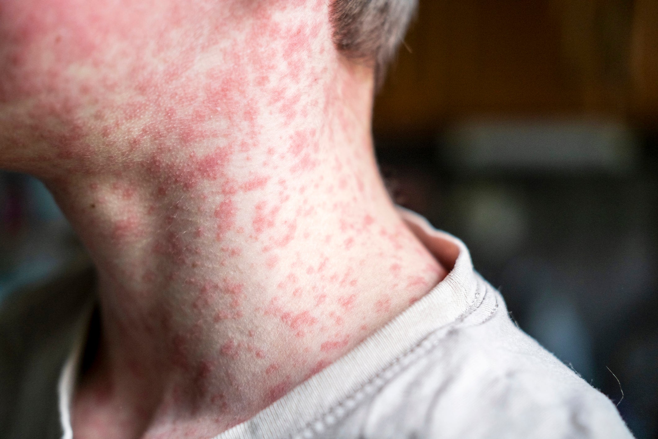  Measles cases are rising in the U.S. Do adults need a vaccine booster? 