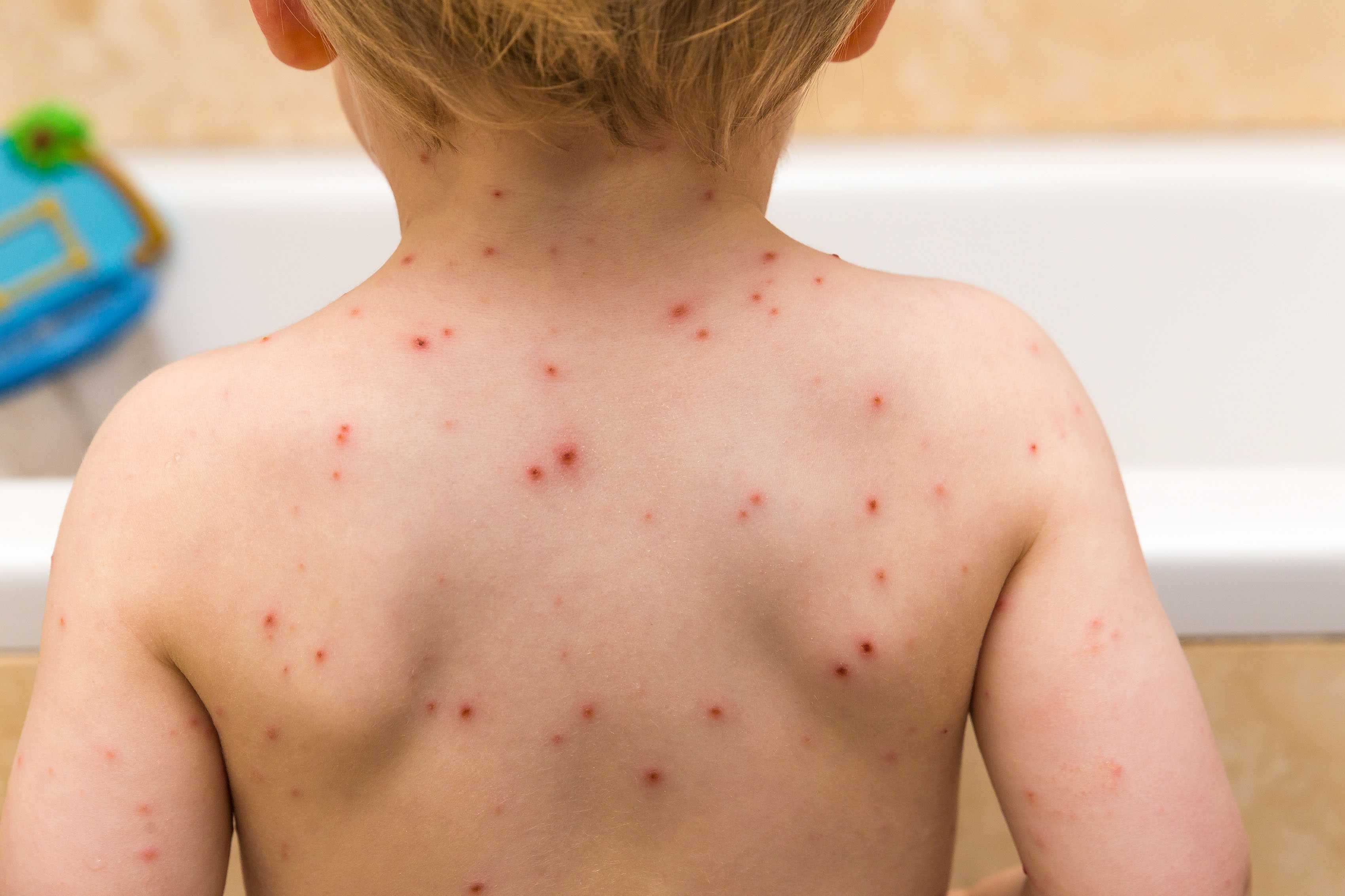   
																Upstate school experiencing chickenpox outbreak among students  
															 